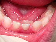 Baby Teeth - pediatric Dentistry